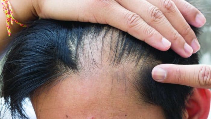 Home Remedies for Baldness