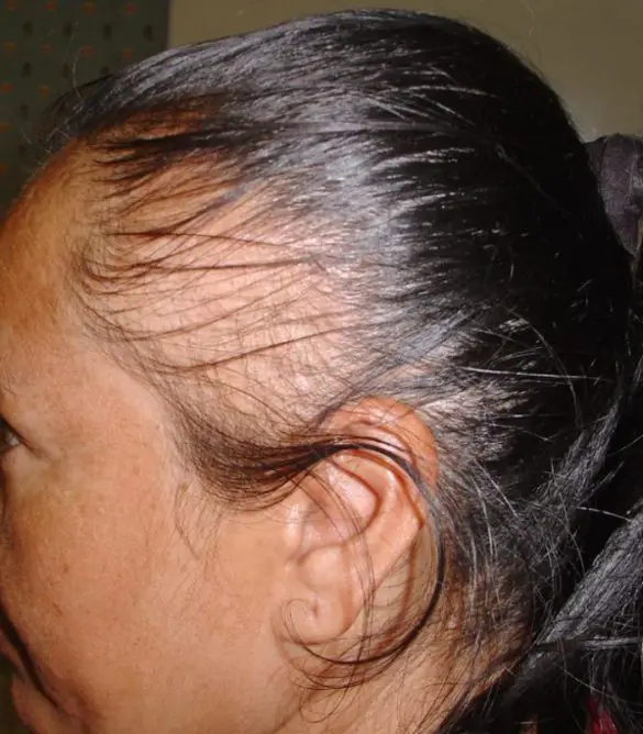 5 Best Scarring Alopecia Natural Treatment SheIdeas