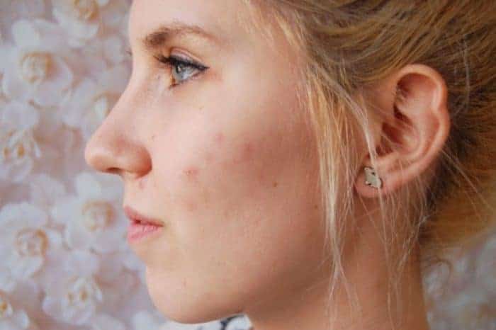 How To Remove Pimple Scars Naturally