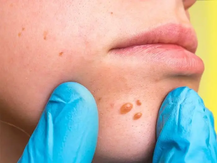 How To Treat Skin Tags